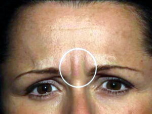 Wysokie dawki BOTOX w leczeniu zmarszczek między brwiami