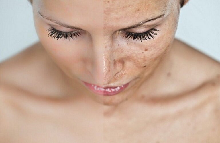 Пилинг — разоблачение мифов