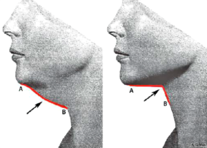 Multidimensional Evaluation and Surgical Approaches to Neck Rejuvenation