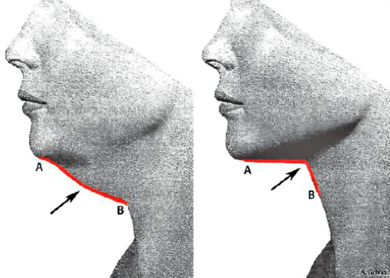 Wielowymiarowa ocena i chirurgiczne podejście do odmładzania szyi