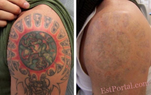 Удаление тату: как быстро и безопасно избавиться от надоевшей татуировки | theGirl