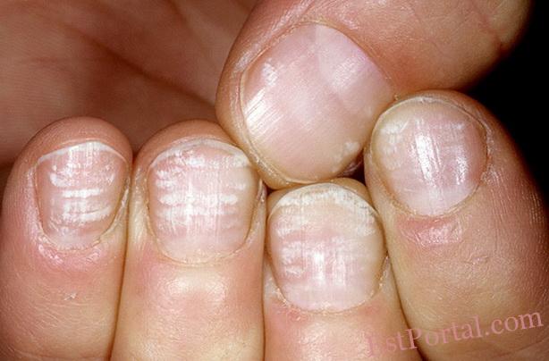 О чем сигнализируют пятна разных цветов на ногтях?