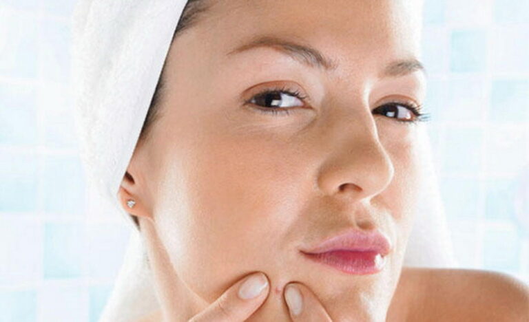 Лікування акне під час вагітності