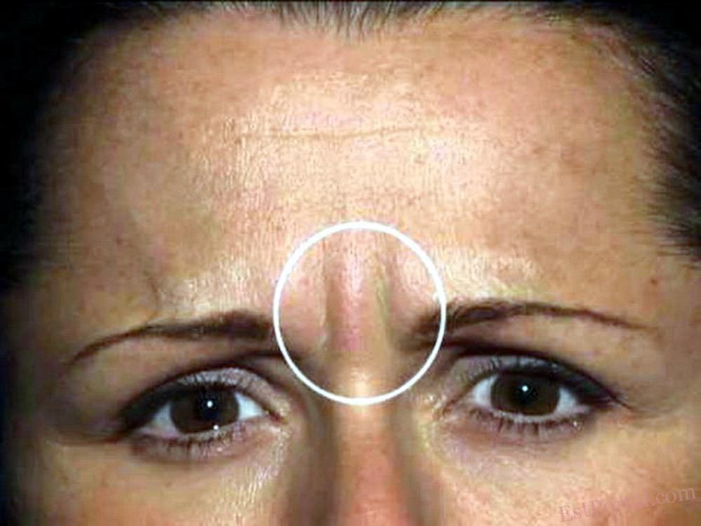 Высокие дозы BOTOX для коррекции глабеллярных морщин