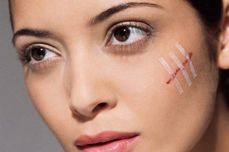 Способи боротьби з рубцями