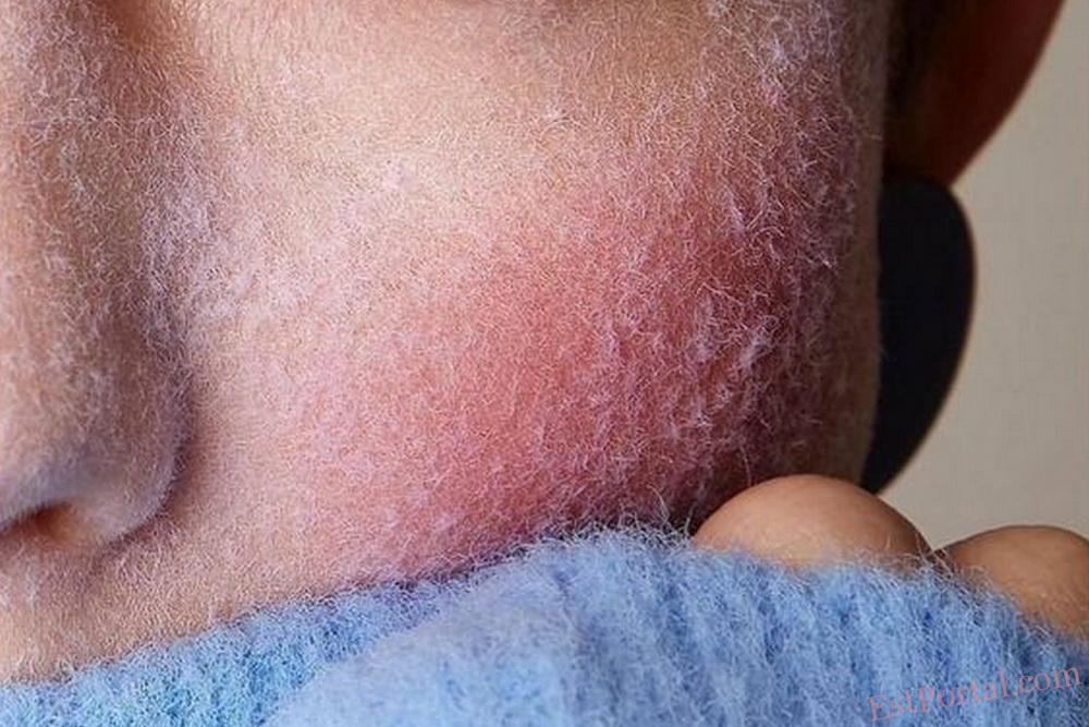 Химические пилинги и мороз: где грань между красотой и риском