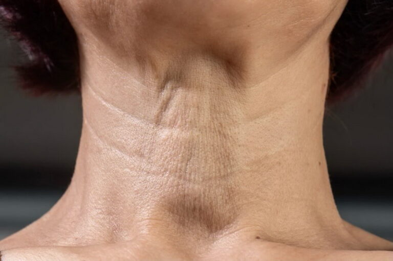 Коли ботулінотерапія платизми провокує в’ялість шиї: клінічні нюанси