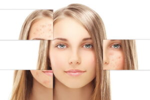 Троє експертів, одна місія: допомогти підліткам подолати акне й тривожність