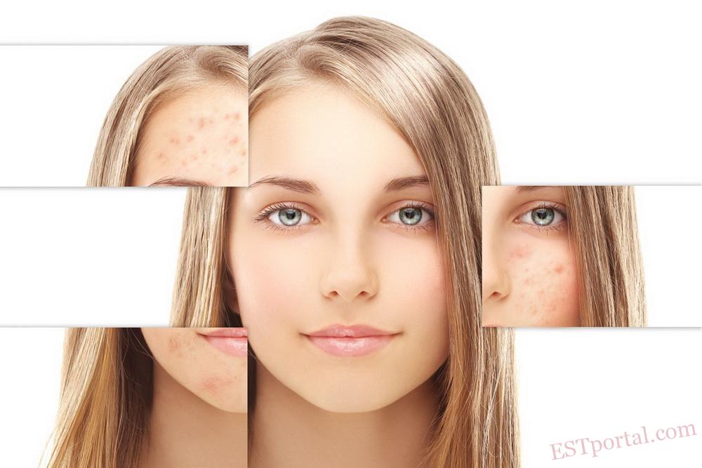 Троє експертів, одна місія: допомогти підліткам подолати акне й тривожність